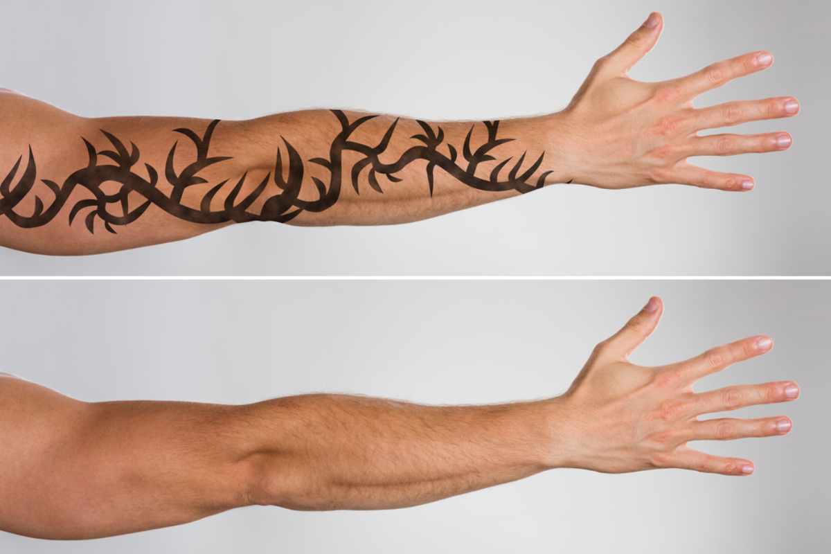 How Long Does It Take to Fully Remove a Tattoo